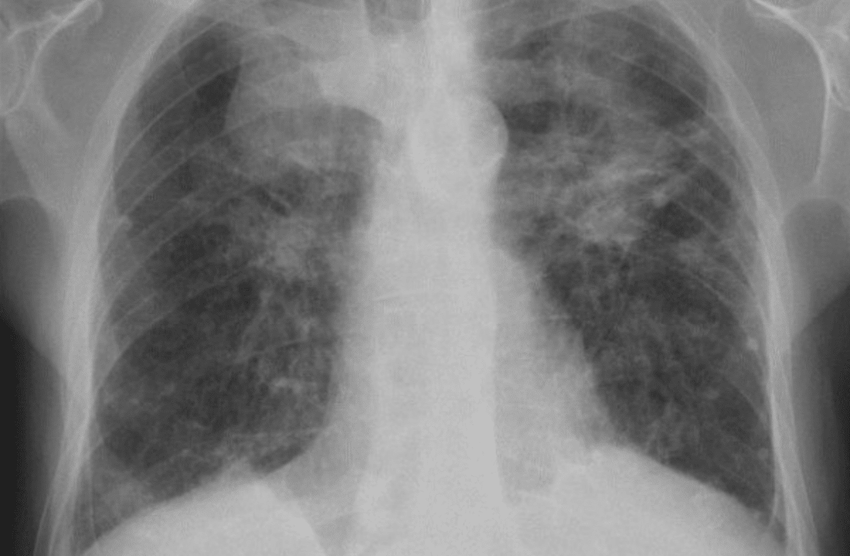 A lung x-ray of a miner with Progressive Massive Fibrosis (PMF), the most severe form of black lung. The lungs are not clear, but instead cloudy.